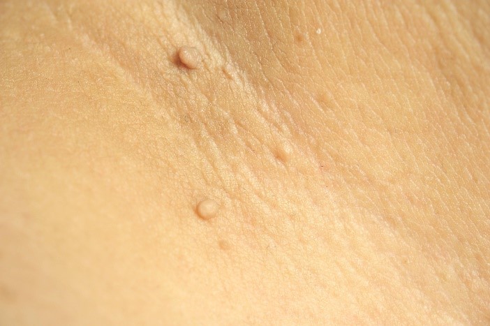 Bradavice - primer 2