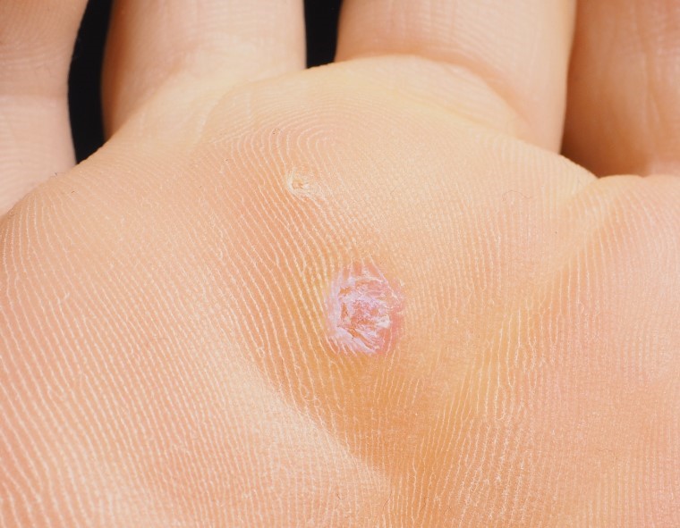 Otiščanec - primer 1